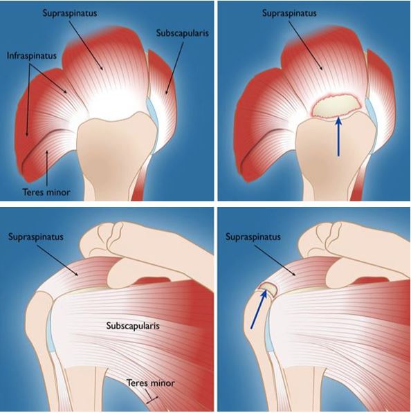 Rotator cuff tear - Specialist surgical treatment with key hole surgery